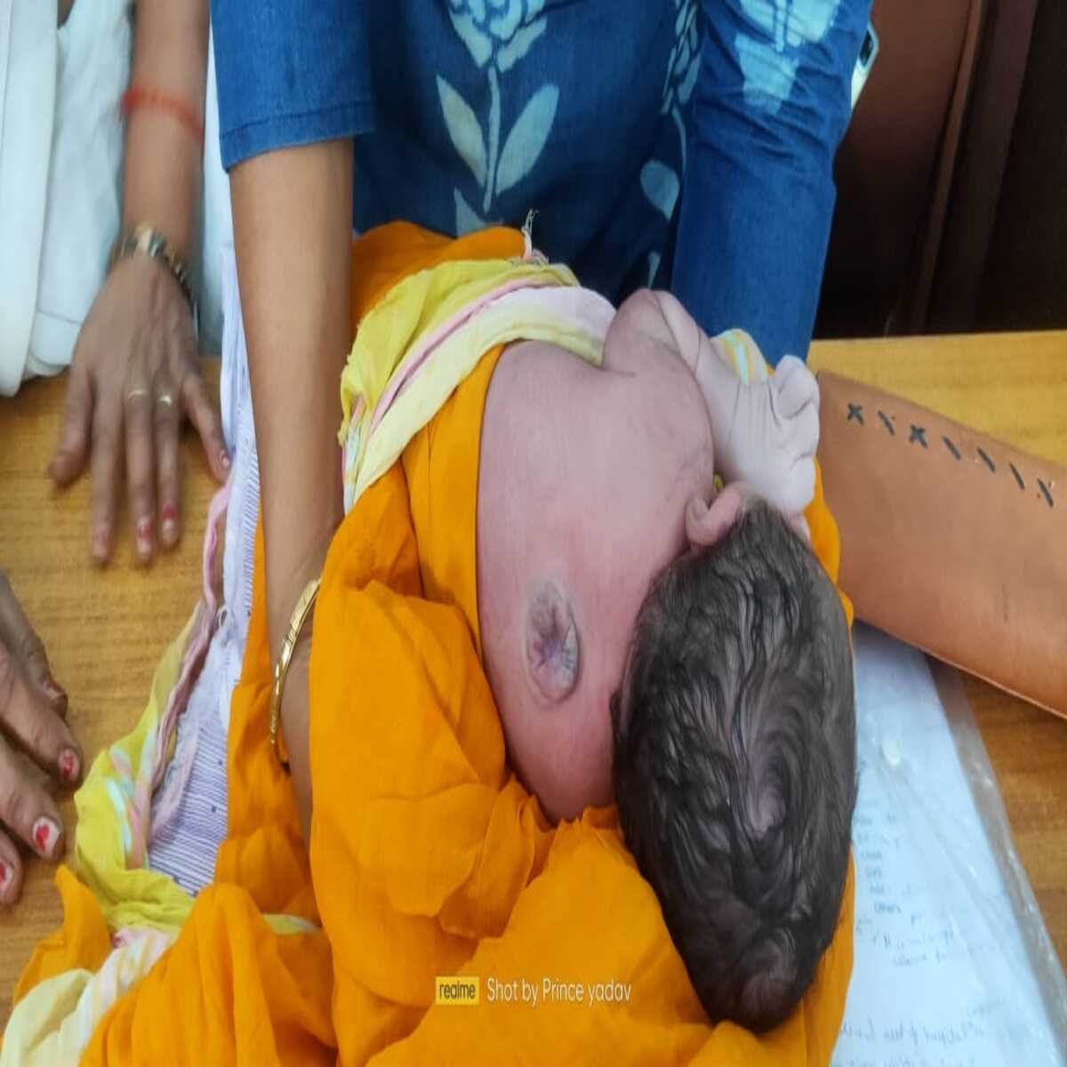 बक्सर : न्यूरल ट्यूब डिफेक्ट से पीड़ित 16 दिन की काजल का होगा समुचित इलाज